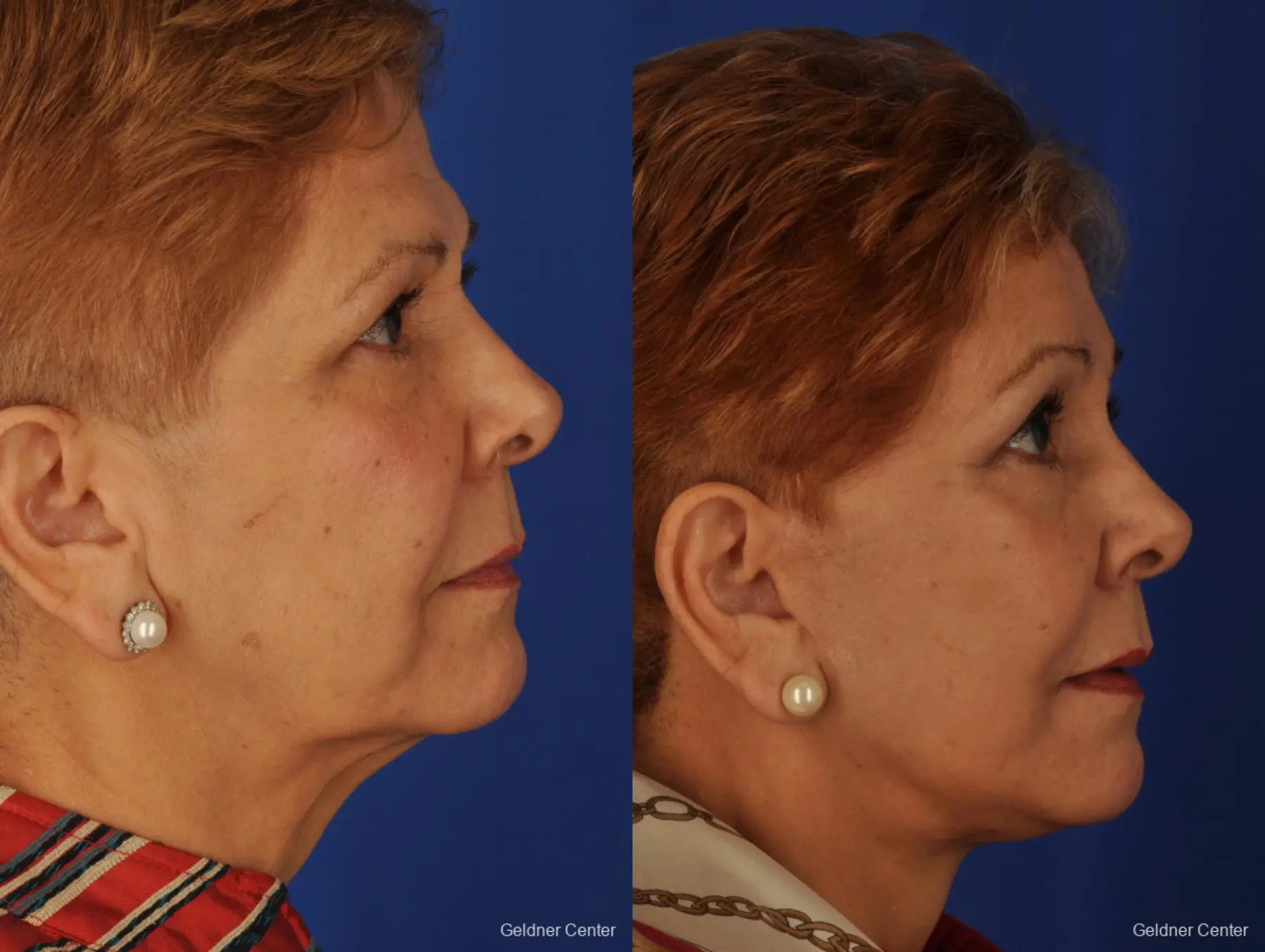 Chicago Brow Lift 2062 - Before and After 2