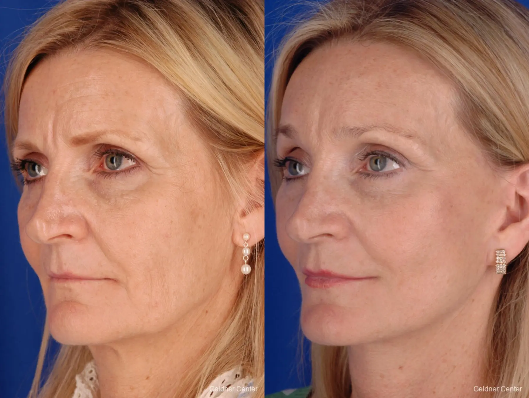 Chicago Brow Lift 2285 - Before and After 4