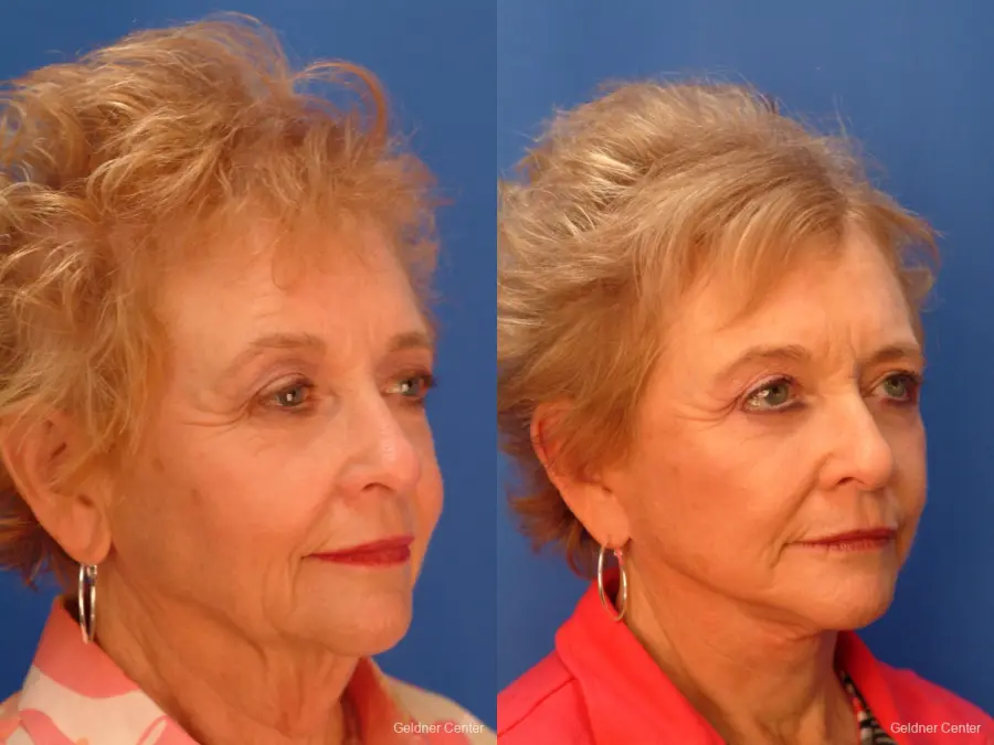 Brow Lift Lake Shore Dr, Chicago 2433 - Before and After 2