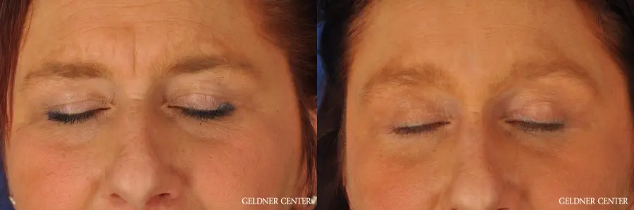 Brow Lift: Patient 4 - Before and After 5