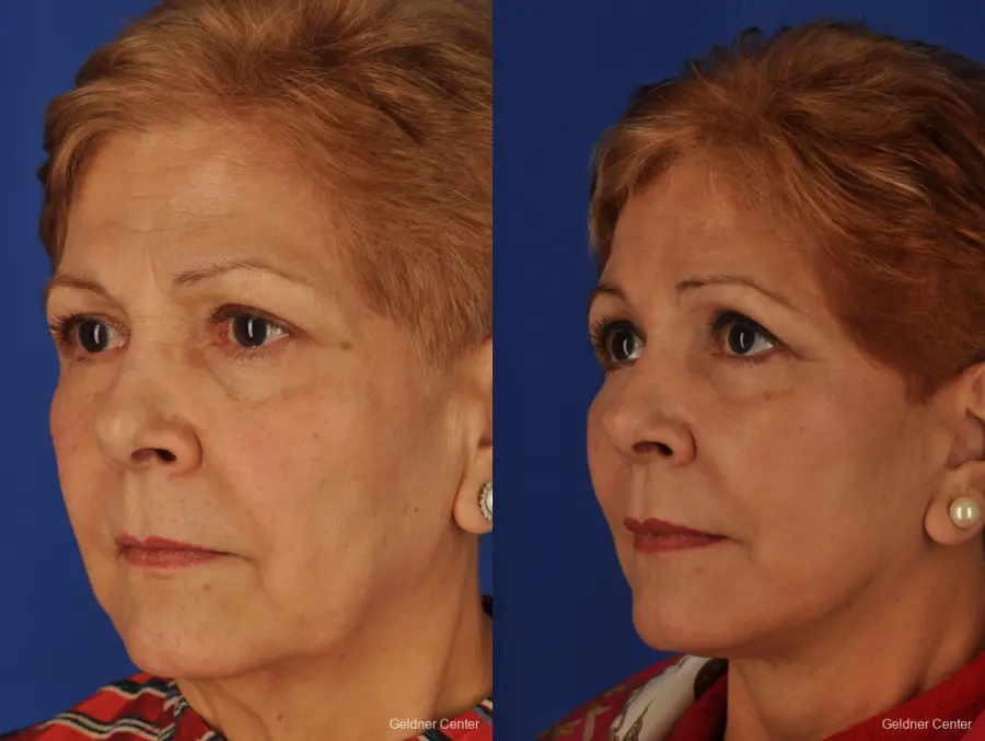 Chicago Brow Lift 2062 - Before and After 4