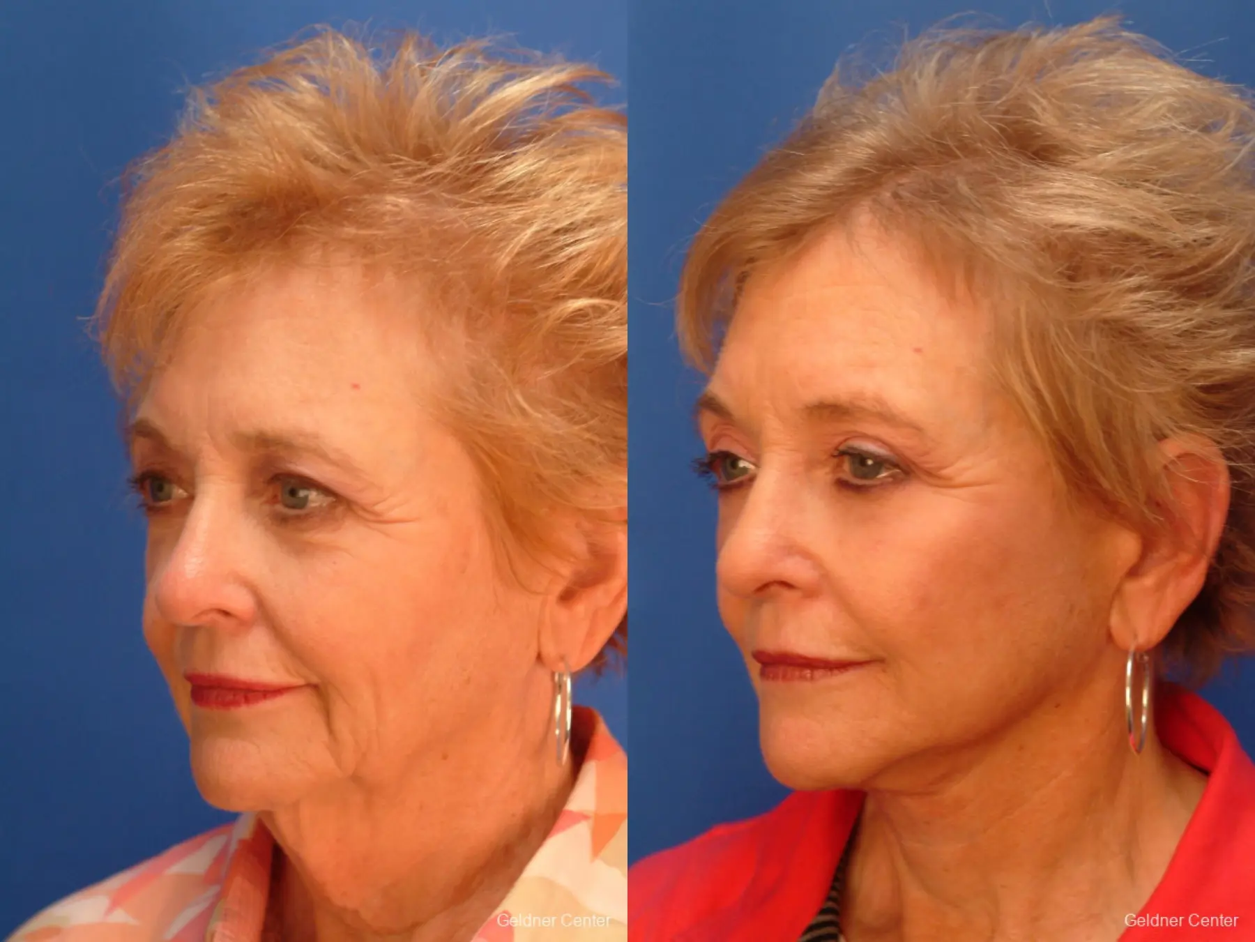 Brow Lift Lake Shore Dr, Chicago 2433 - Before and After 3