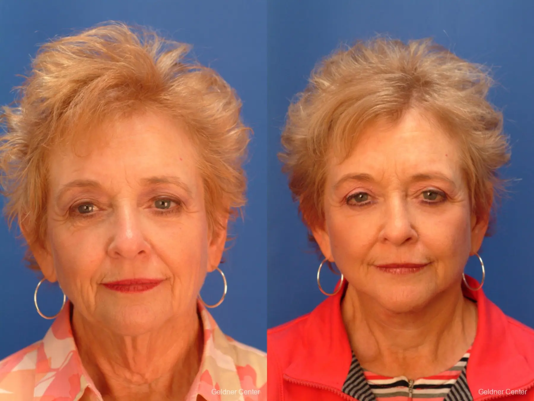 67 year old woman from Chicago, before and after brow lift plastic surgery - Before and After