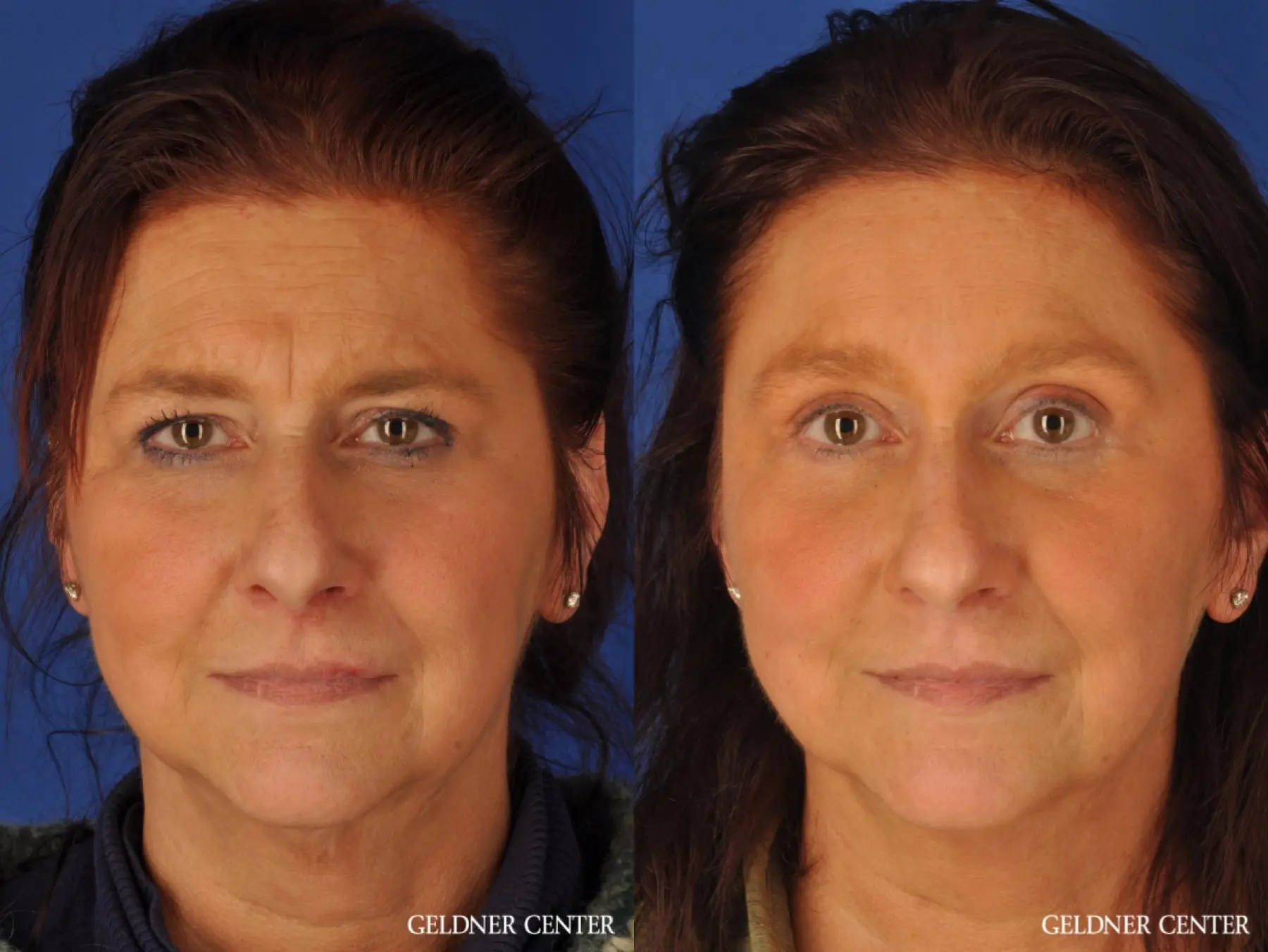 Woman Over 45, 185llbs or more, 5'4" to 5'7", endoscopic brow lift - Before and After