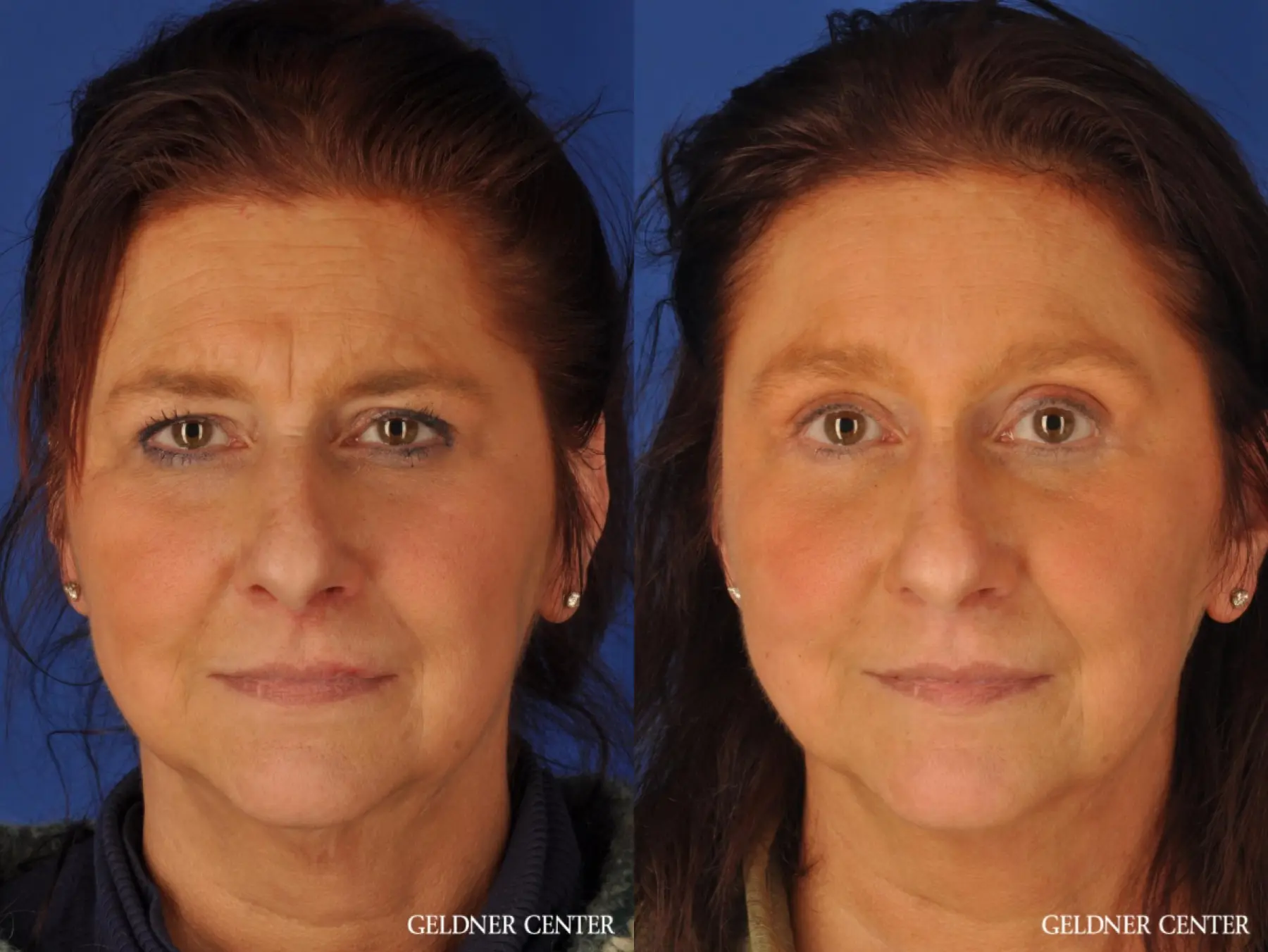 Brow Lift: Patient 4 - Before and After  