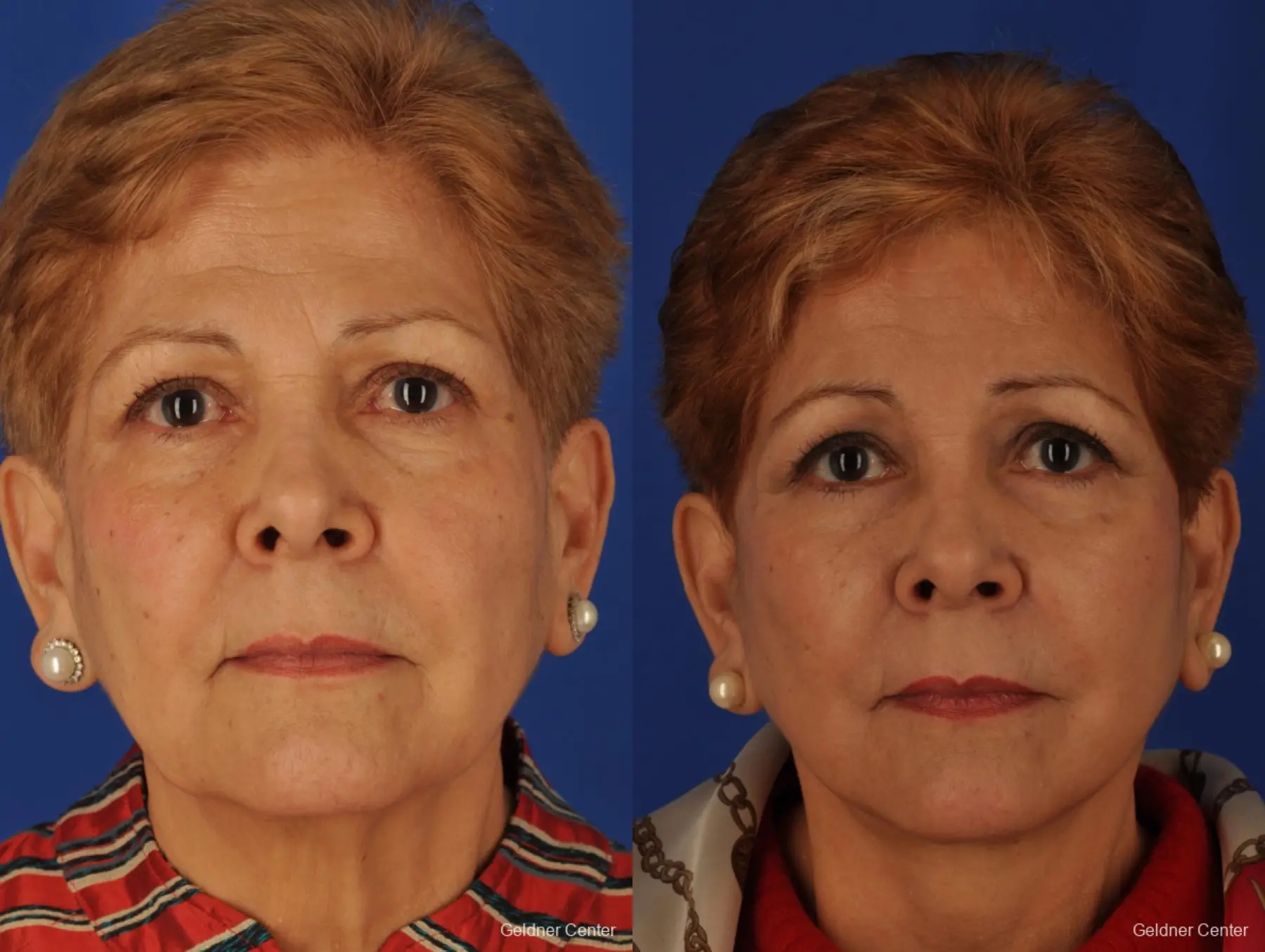 67 year old woman from Chicago, endoscopic brow lift - Before and After