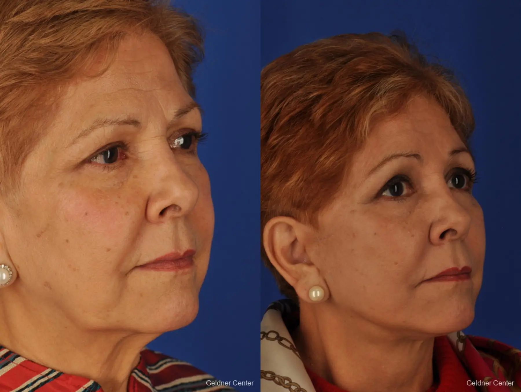 Chicago Brow Lift 2062 - Before and After 3