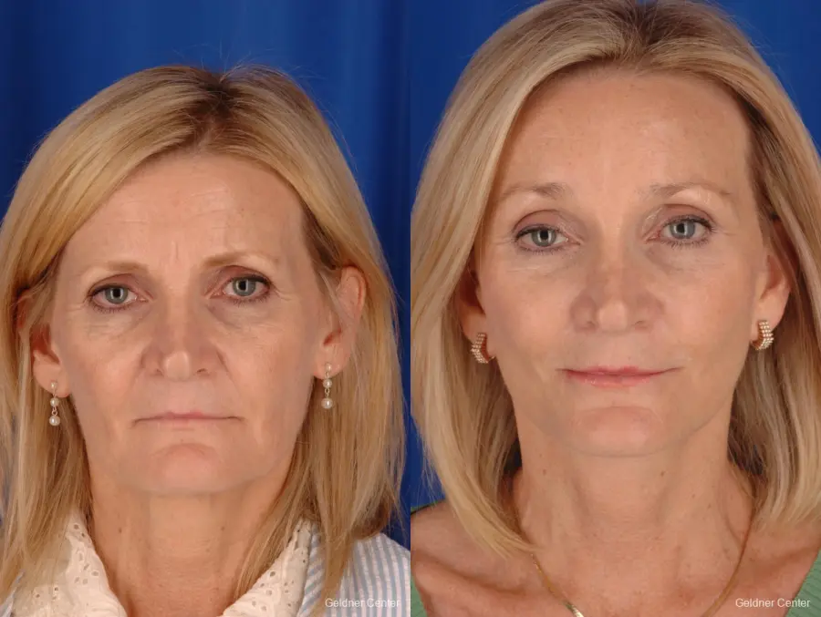 Chicago Brow Lift 2285 - Before and After