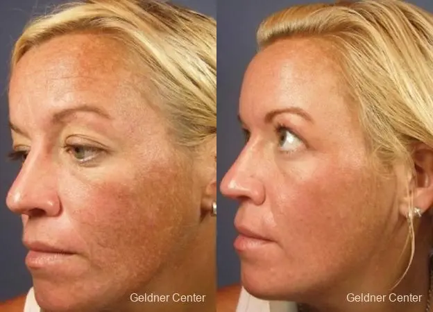 Chicago VI chemical peel patient 2313 before and after photos - Before and After