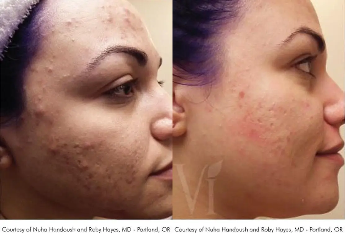 Chemical VI Peel before and after photos Lake Shore Dr, Chicago 2315 - Before and After 1