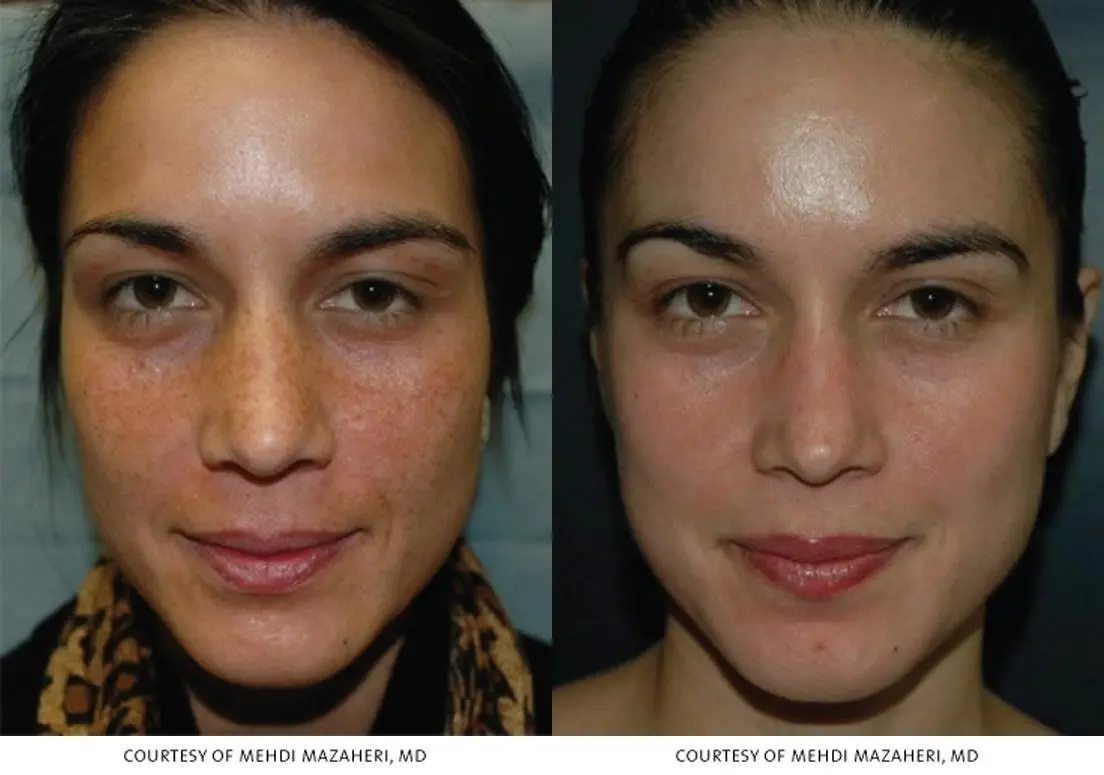 Chicago VI Peel chemical peel patient 2314 before and after photos - Before and After