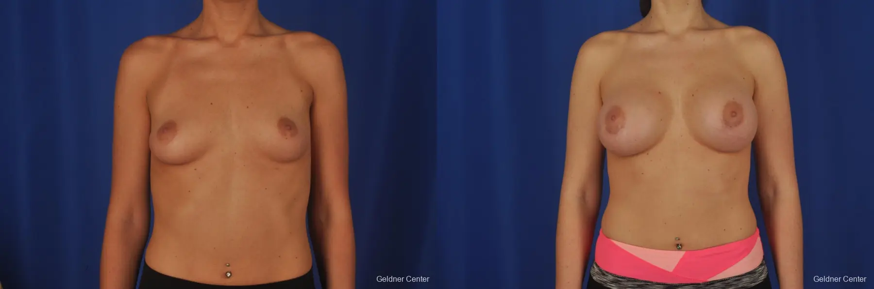 Chicago Complex Breast Augmentation 2381 - Before and After 1