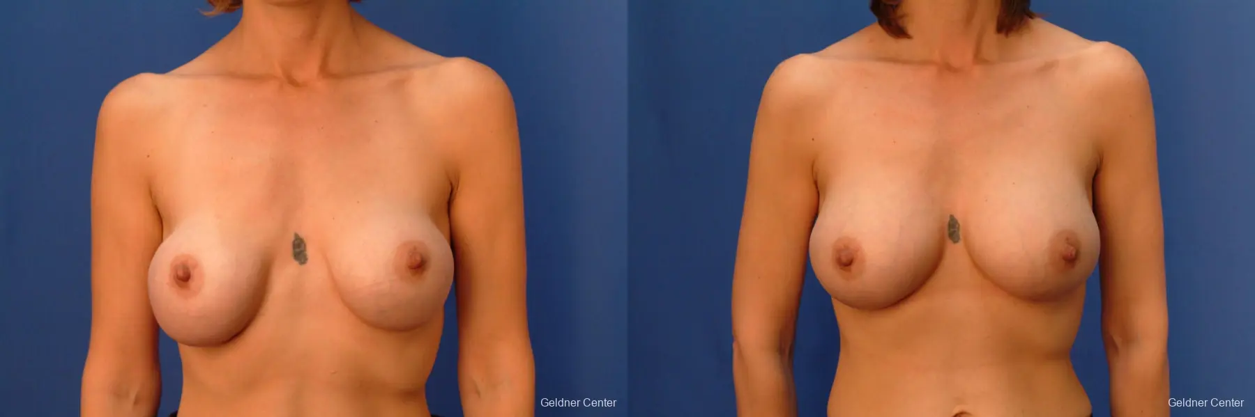 Chicago Complex Breast Augmentation 2415 - Before and After 1