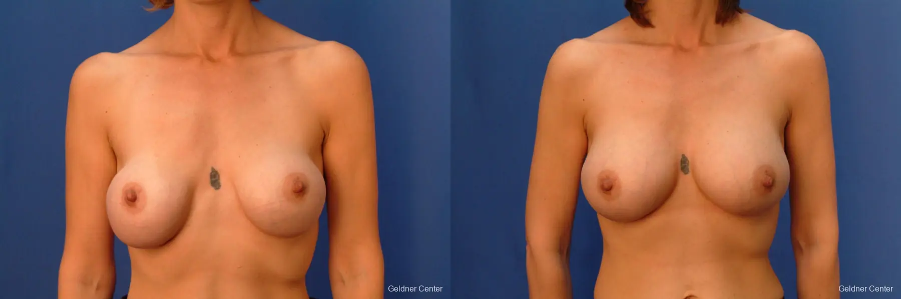 Chicago Complex Breast Augmentation 2415 - Before and After