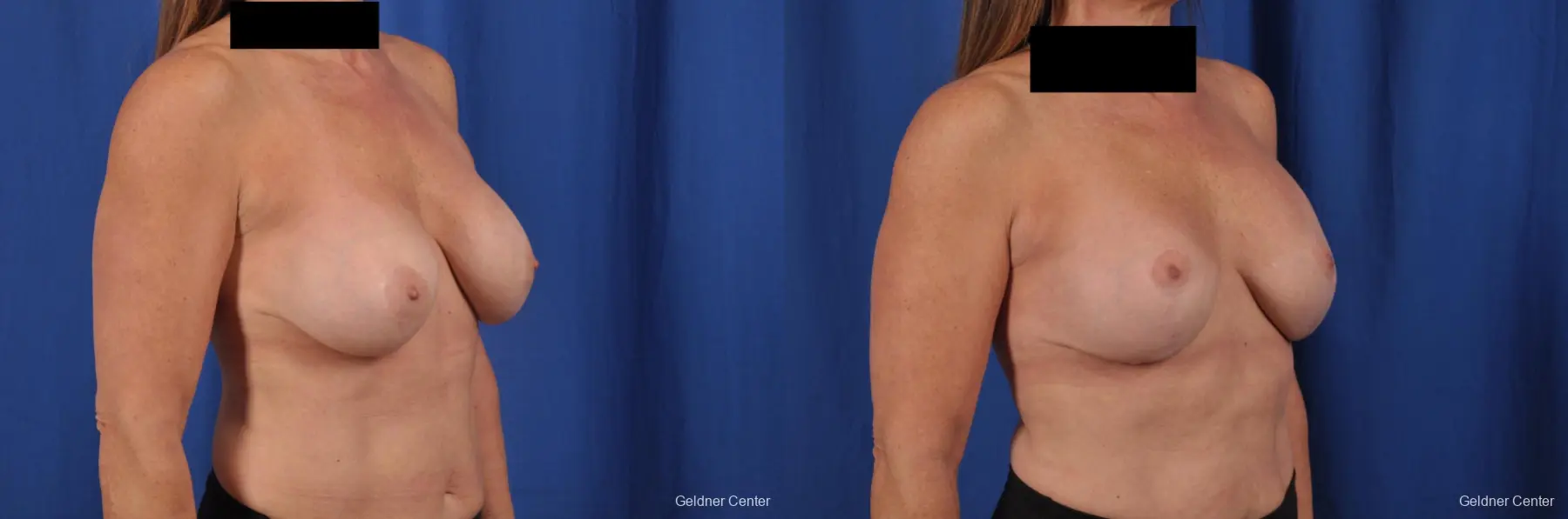 Complex Breast Augmentation: Patient 35 - Before and After 3