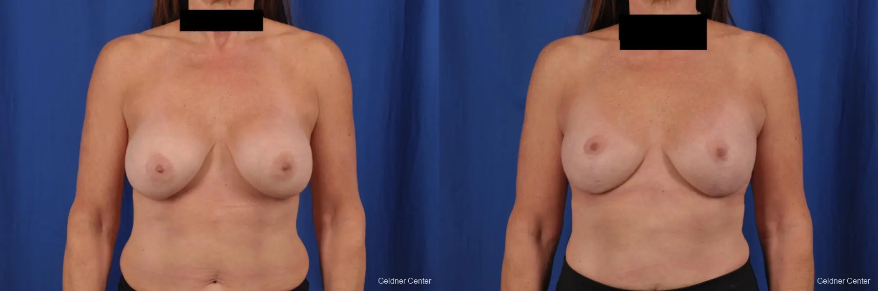 Complex Breast Augmentation: Patient 35 - Before and After 1