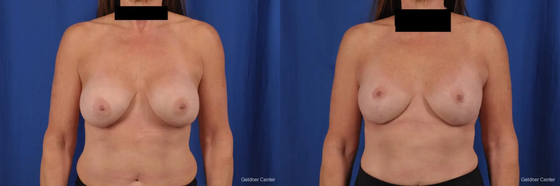 Complex Breast Augmentation: Patient 35 - Before and After  