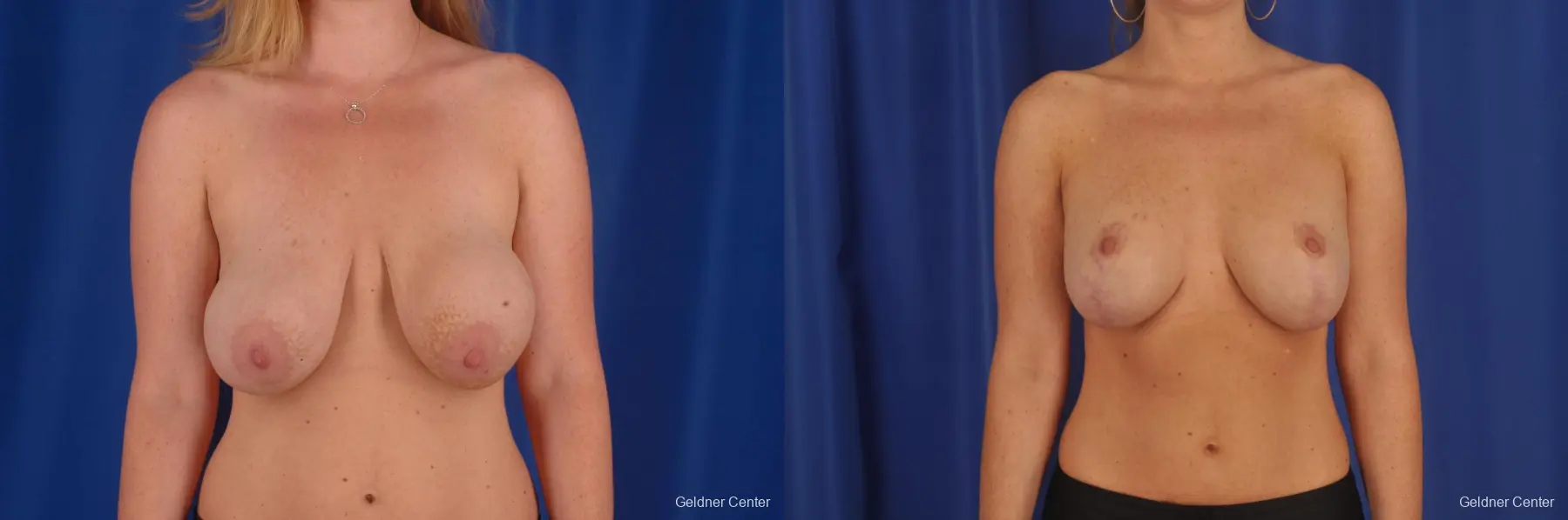 Complex Breast Augmentation Lake Shore Dr, Chicago 2290 - Before and After 1