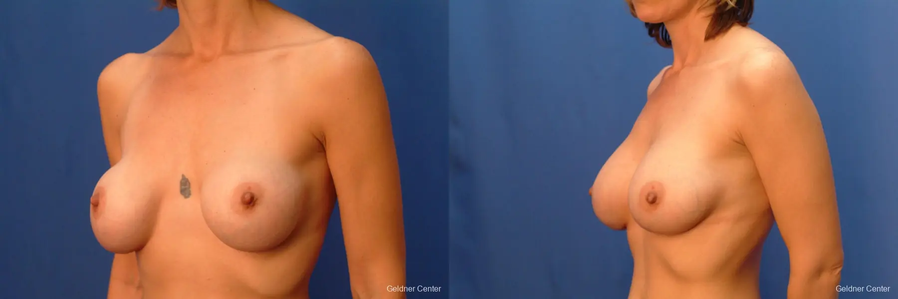 Chicago Complex Breast Augmentation 2415 - Before and After 4