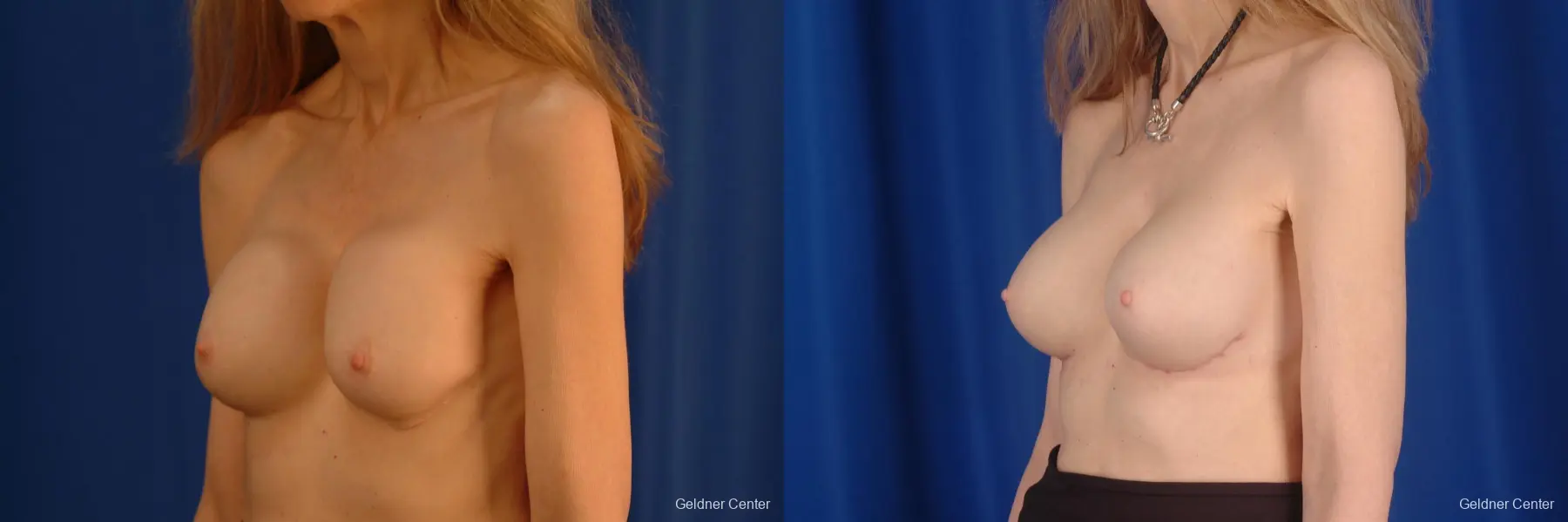 Complex Breast Augmentation Hinsdale, Chicago 2398 - Before and After 5
