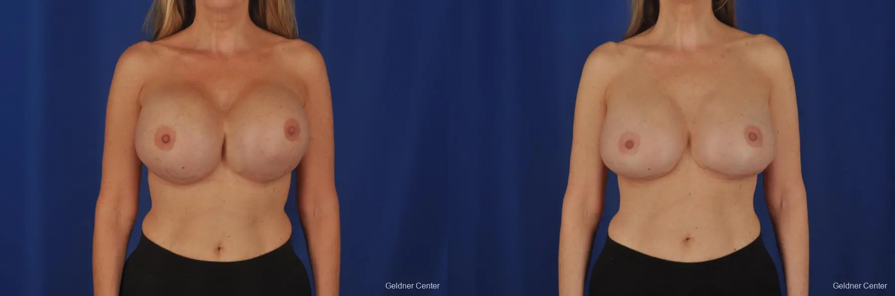 Complex Breast Augmentation Lake Shore Dr, Chicago 2389 - Before and After 1