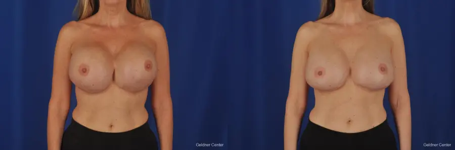 Complex Breast Augmentation Lake Shore Dr, Chicago 2389 - Before and After