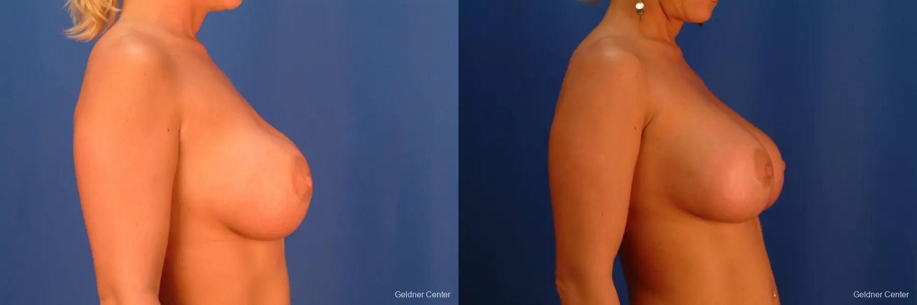 Complex Breast Augmentation Streeterville, Chicago 2428 - Before and After 2
