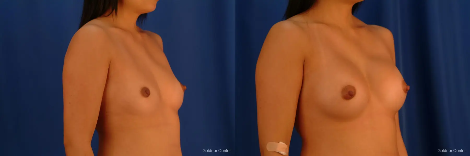 Complex Breast Augmentation Hinsdale, Chicago 2622 - Before and After 3