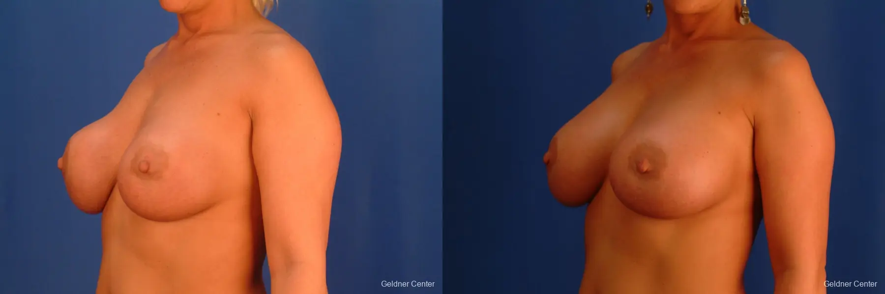 Complex Breast Augmentation Streeterville, Chicago 2428 - Before and After 4