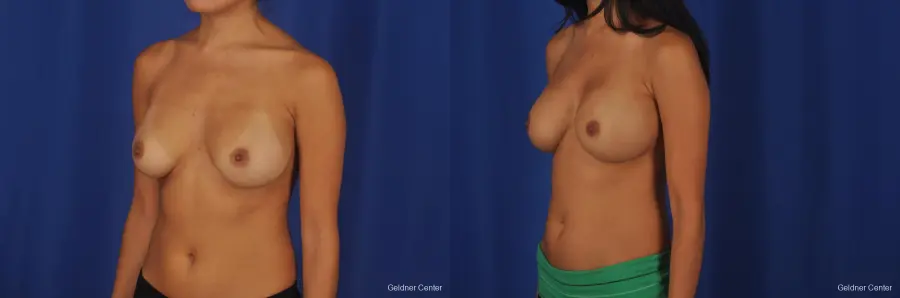 Complex Breast Augmentation Streeterville, Chicago 2297 - Before and After 4