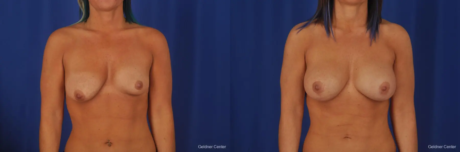 Chicago Complex Breast Augmentation 2336 - Before and After 1