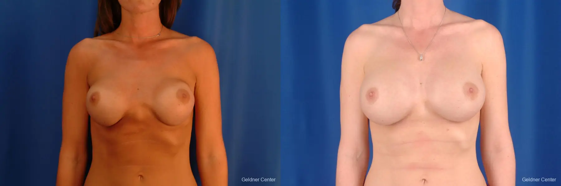 Complex Breast Augmentation Streeterville, Chicago 2620 - Before and After 1