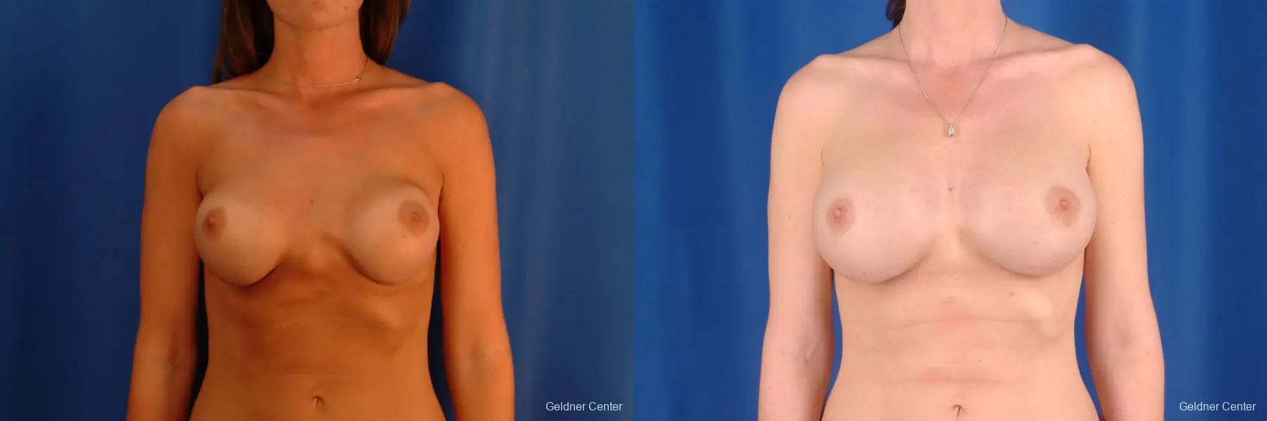 Complex Breast Augmentation Streeterville, Chicago 2620 - Before and After