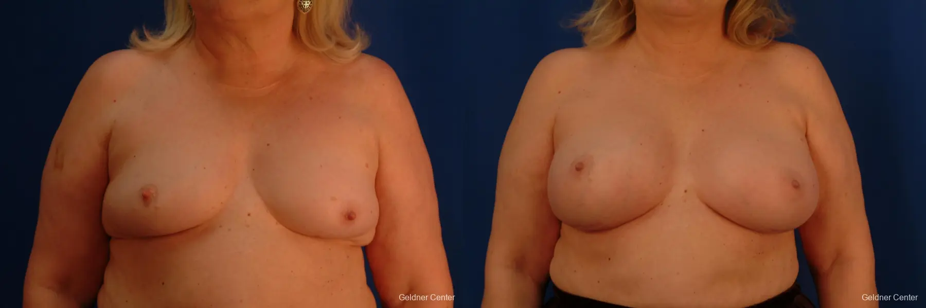 Complex Breast Augmentation Hinsdale, Chicago 2430 - Before and After