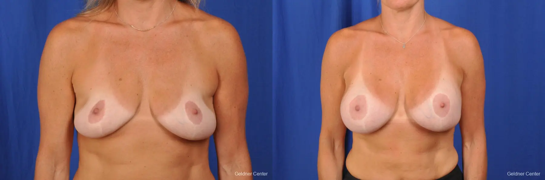 Complex Breast Augmentation Streeterville, Chicago 2392 - Before and After 1