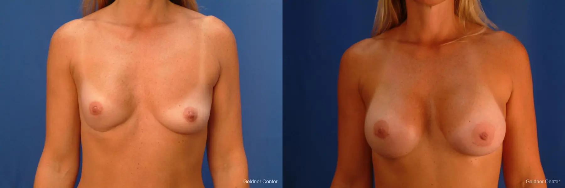Complex Breast Augmentation Lake Shore Dr, Chicago 2419 - Before and After 1