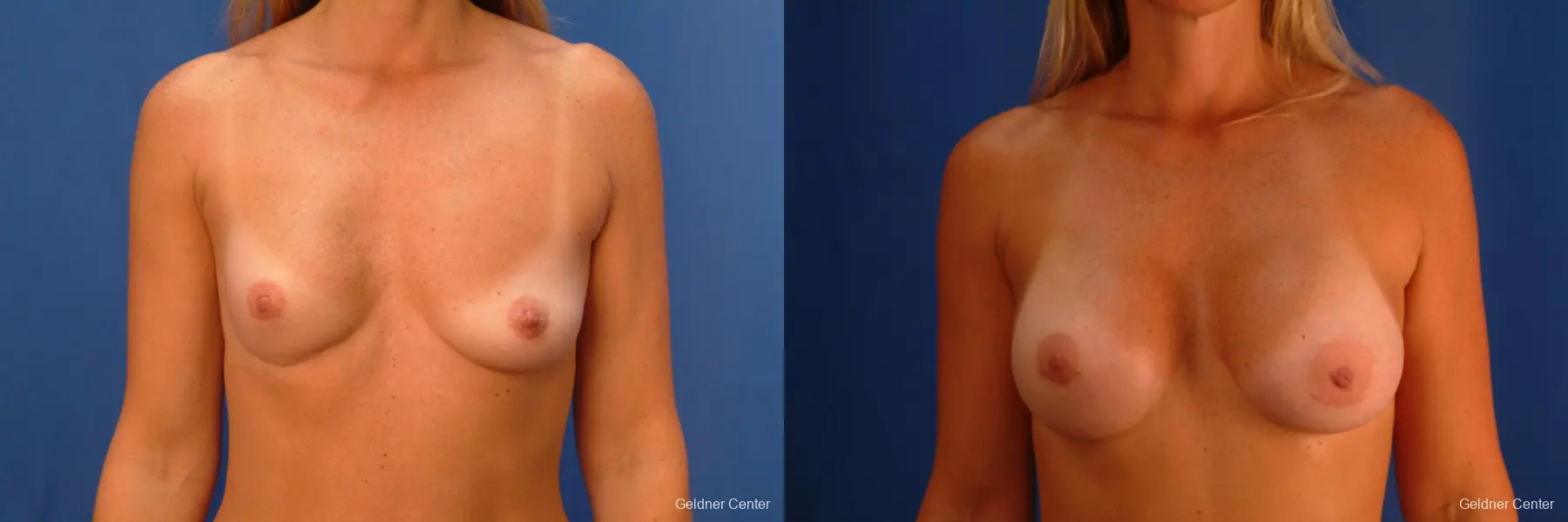 Complex Breast Augmentation Lake Shore Dr, Chicago 2419 - Before and After