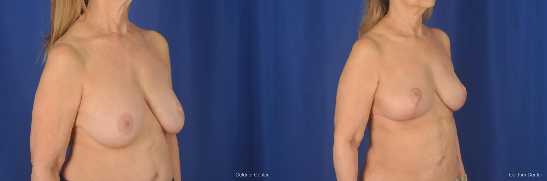 Complex Breast Augmentation: Patient 3 - Before and After 2