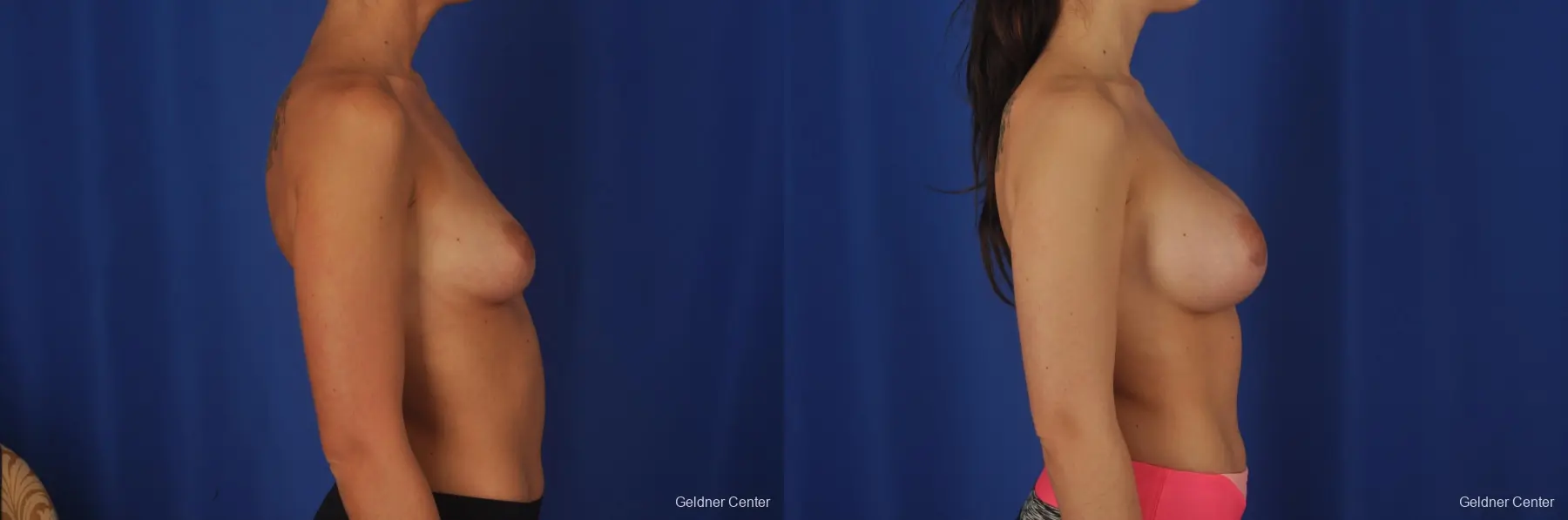 Chicago Complex Breast Augmentation 2381 - Before and After 2