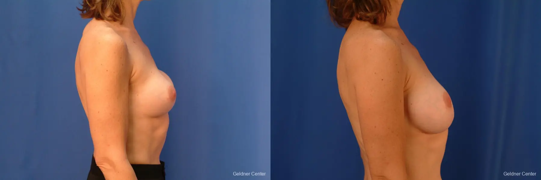 Chicago Complex Breast Augmentation 2445 - Before and After 2