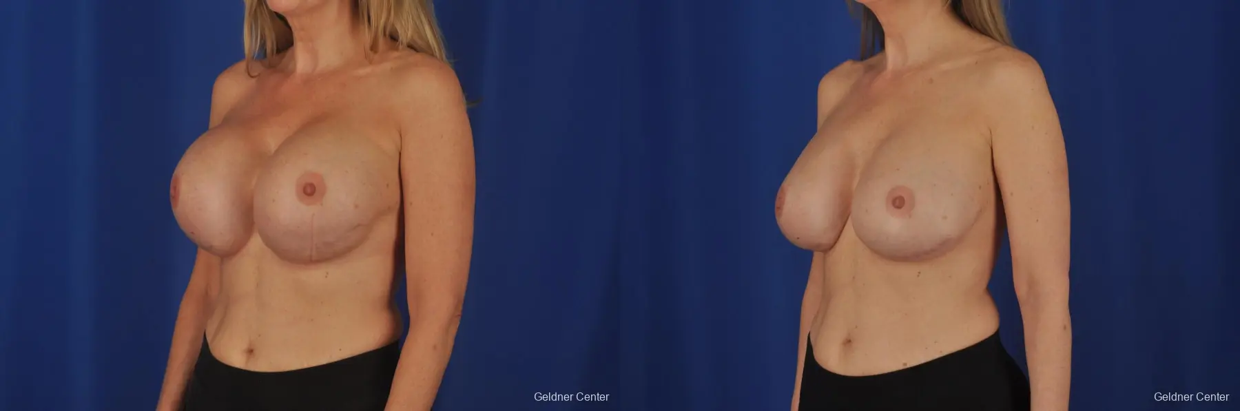 Complex Breast Augmentation Lake Shore Dr, Chicago 2389 - Before and After 4