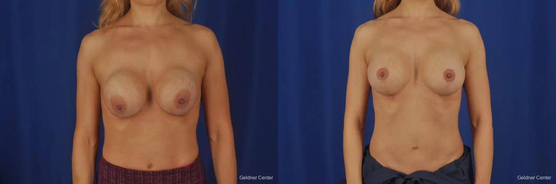 Chicago Complex Breast Augmentation 2073 - Before and After 1