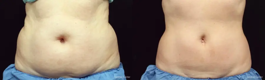 Chicago Coolsculpting 2320 - Before and After