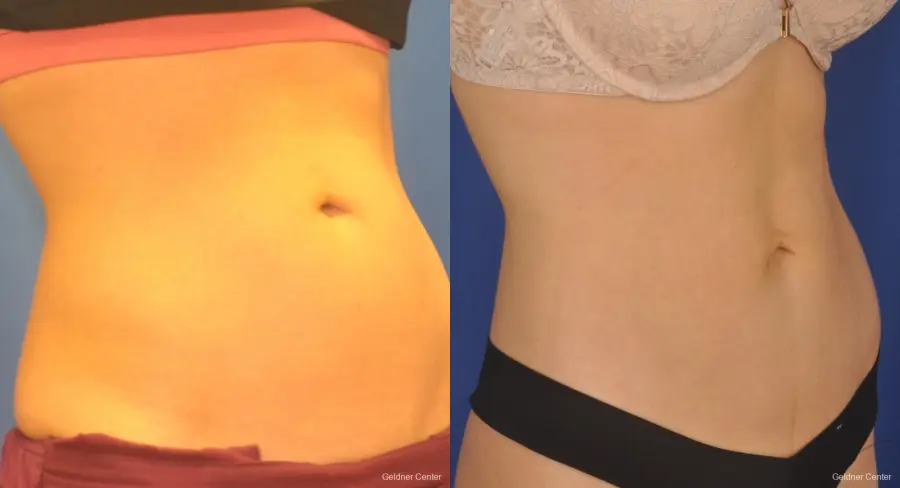 CoolSculpting®: Patient 2 - Before and After 1