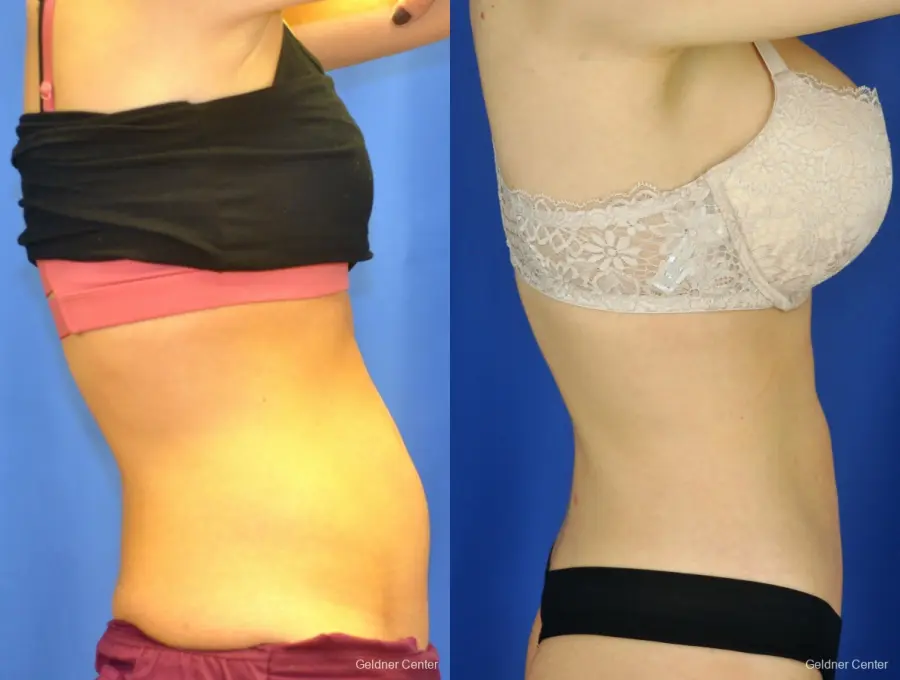 CoolSculpting®: Patient 2 - Before and After 2