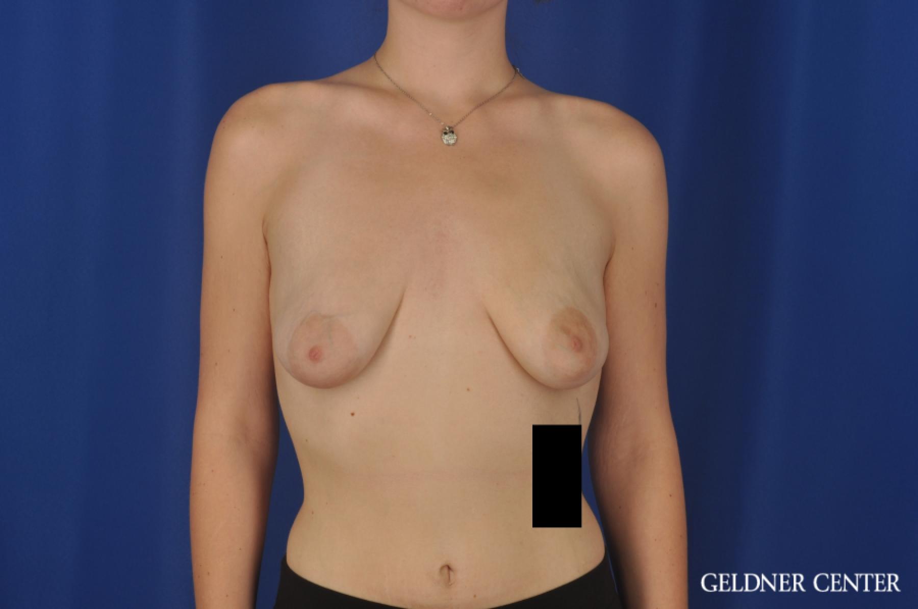 Breast Augmentation Streeterville, Chicago 5547 - Before 1
