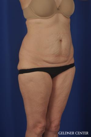 Chicago Abdominoplasty 11851 - Before Image 2