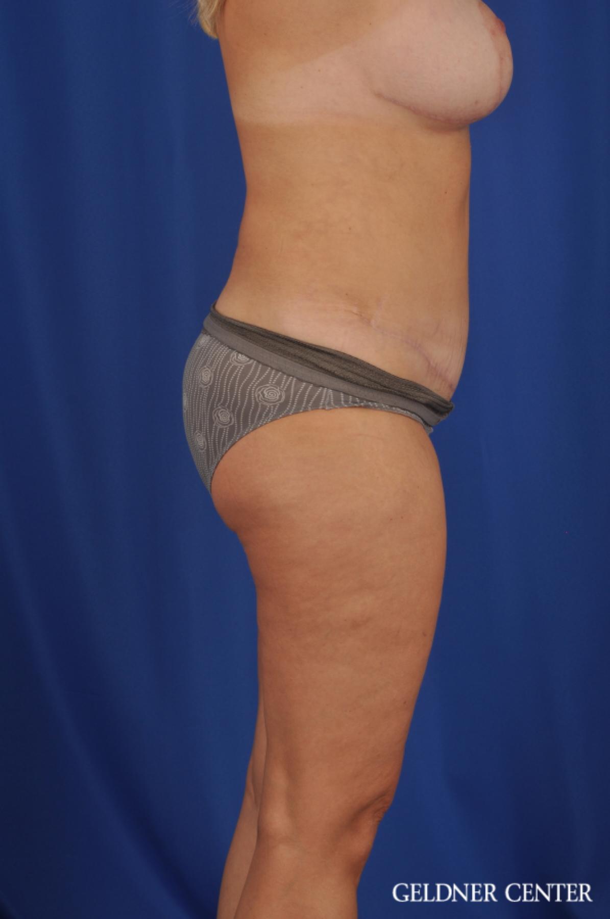 Tummy Tuck: Patient 23 - After 3