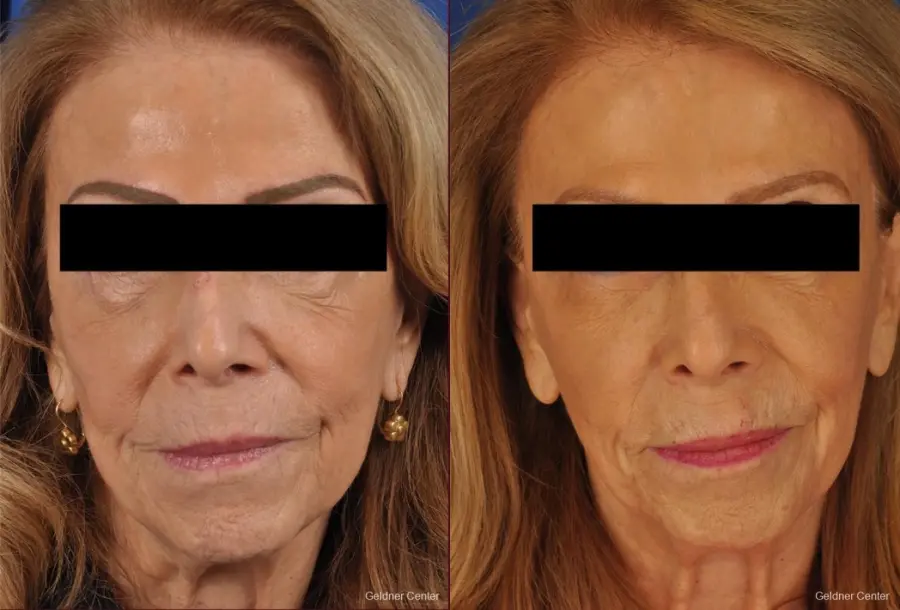 EMFACE™: Patient 1 - Before and After  