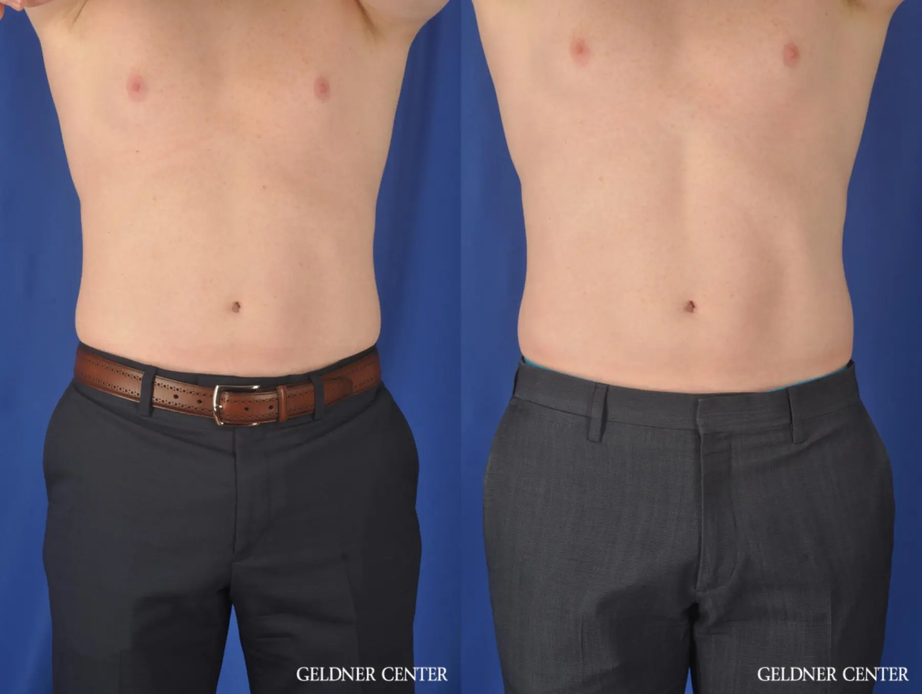 Non-Surgical Male Emsculpt - Before and After